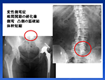 基礎から臨床まで 股関節疾患の理学療法～ 変形性股関節症のメカニズム